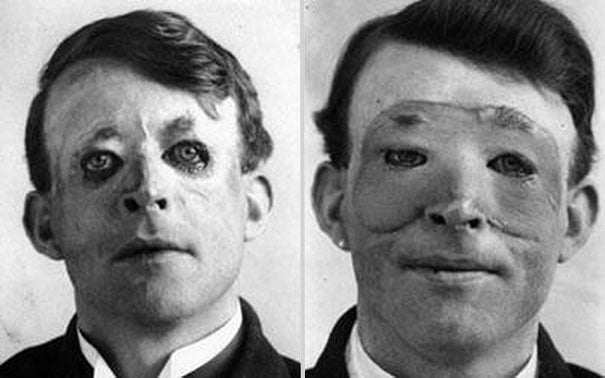 Walter Yeo, uno de los primeros en someterse a una cirugía plástica y transplante de piel, 1917