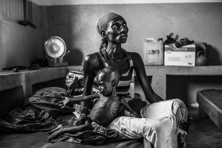Mamá e hijo de dos años con desnutrición severa 
