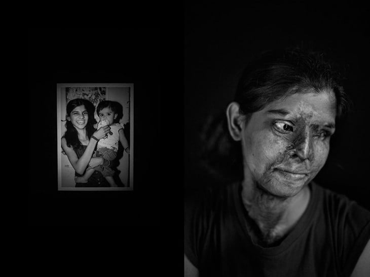 Fotografía del antes y después de una mujer atacada con ácido 