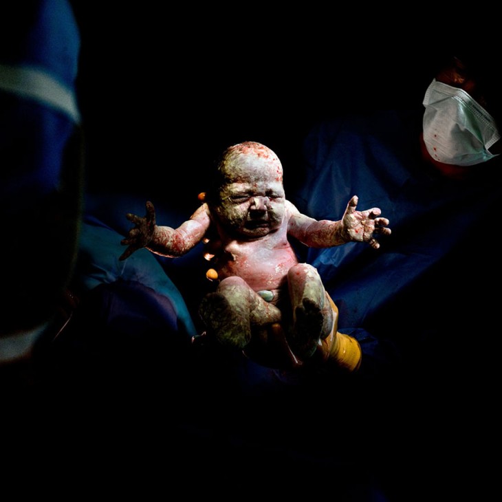 bebé recién nacido a través de cesárea 