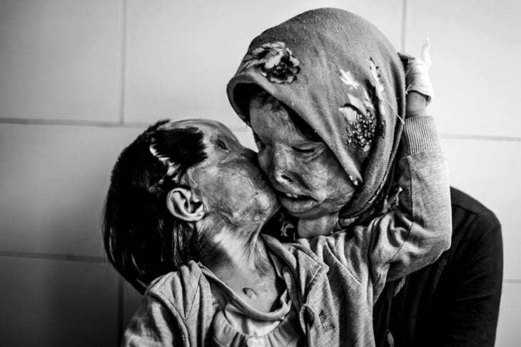 madre e hija desfiguradas por ácido comparten un beso en la mejilla