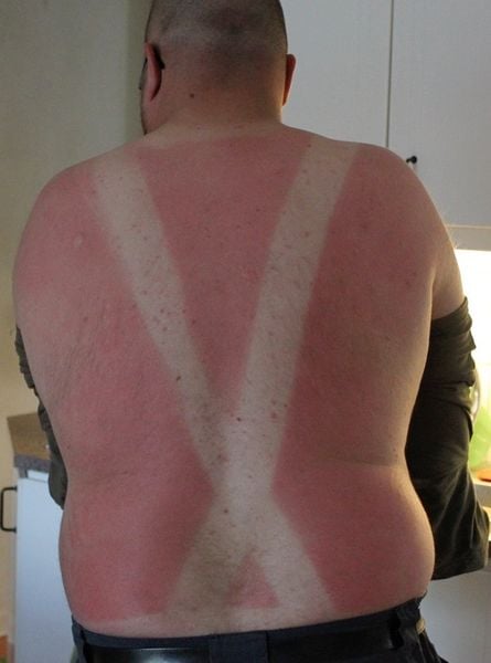 hombre se le marcan los tirantes del pantalon tras pasar varias horas en el sol