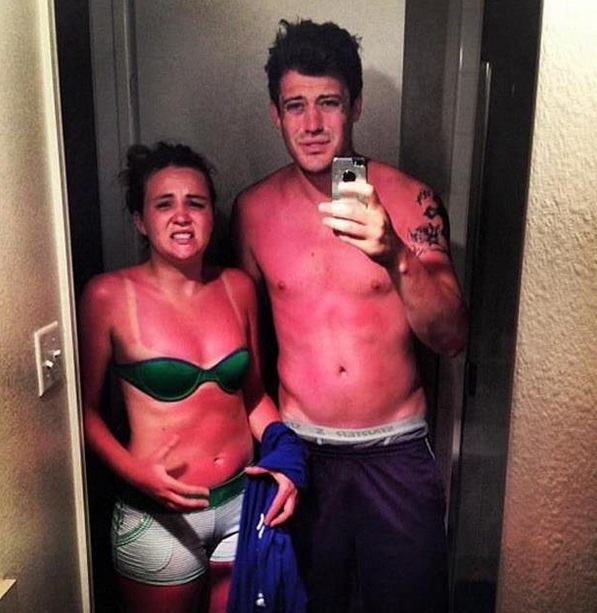 pareja quemada por el sol a falta del bloqueador solar en la piel