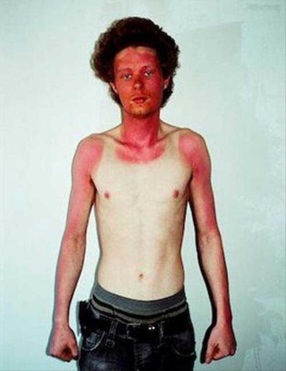 hombre muy blanco solo se le marco la camisa por quemaduras de sol