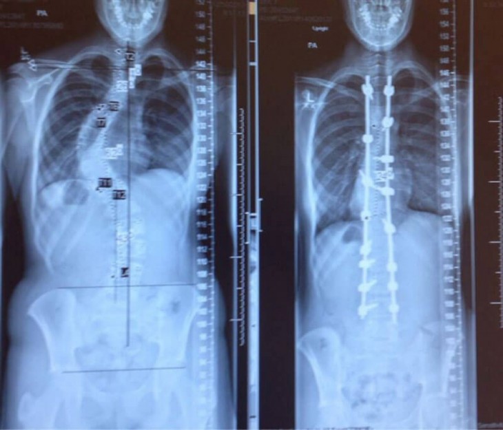 Radiografías de una columna vertebral después de una escoliosis