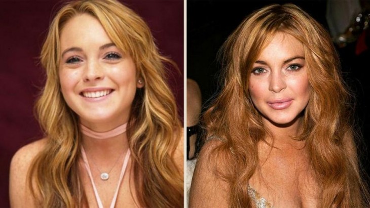 lindsay lohan cirugias