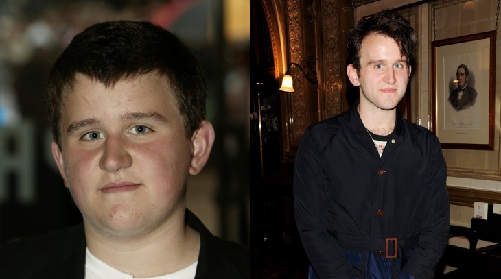 Harry Melling en una fotografía que muestra el antes y después 