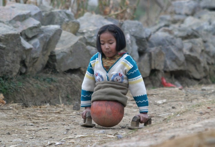 NIÑ CAMINANDO CONSUS MULETAS DE CEPILLO Y SU BALON DE BASQUETBALL