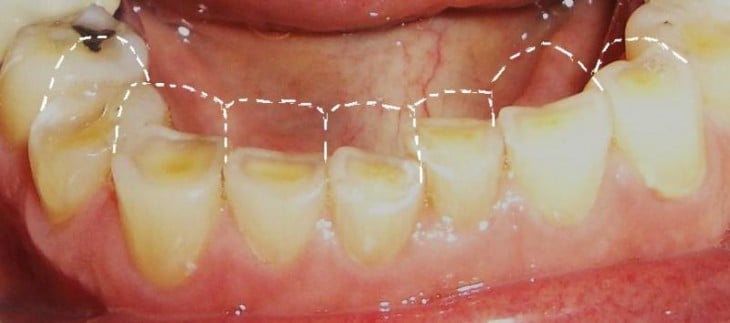 morderte las uñas provoca erosión dental 