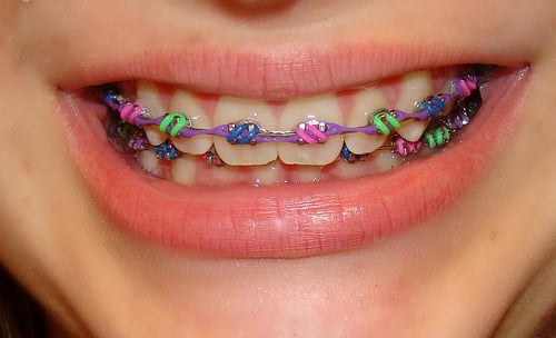 boca de una chica con brackets de colores 