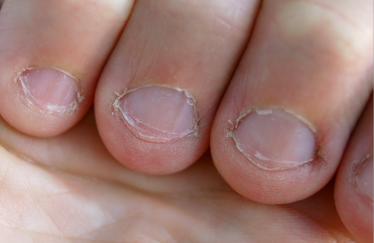 fotografía de uñas dañadas de tanto morderlas 