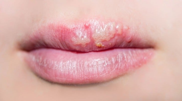 unos labios de una persona con herpes bucal provocado por morderse las uñas 