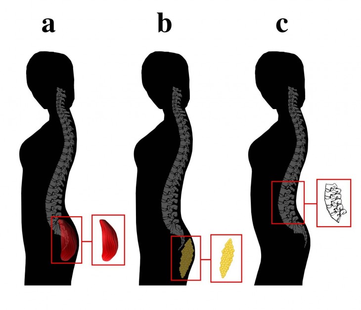 dibujos a blanco y negro del cuerpo de tres mujeres enfocándose en una curvatura lumbar 