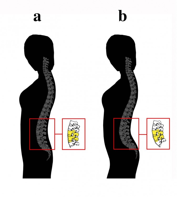 dibujos a blanco y negro del cuerpo de dos mujeres enfocándose principalmente en la curvatura de la columna