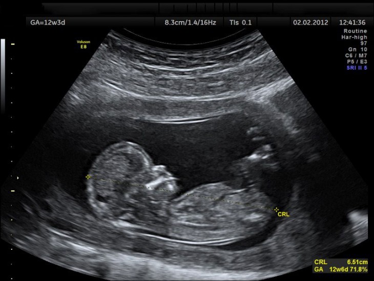 bebé de 4 meses en el vientre maternoa través de un ultrasonido