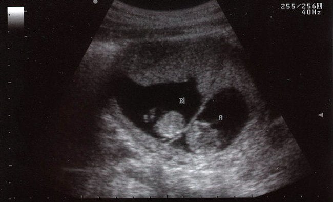 embriones gemelos de dos meses