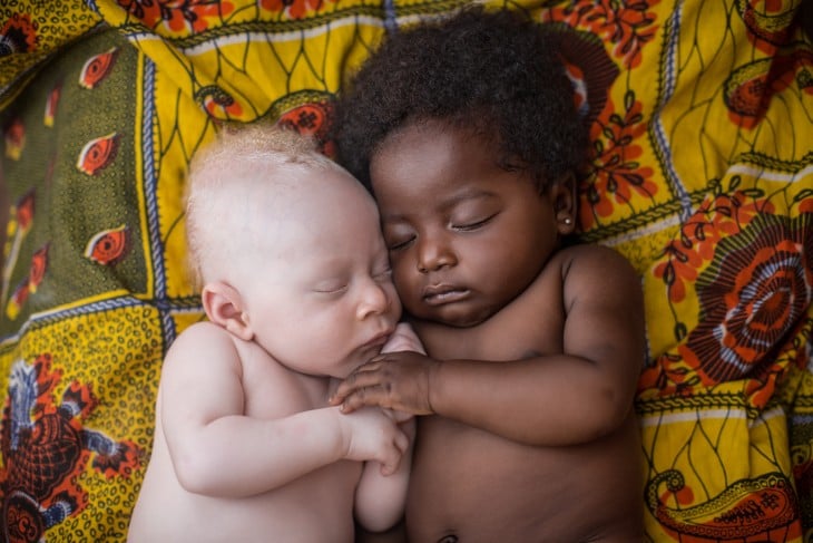 foto de un bebé blanco dormido junto a un bebé albino 