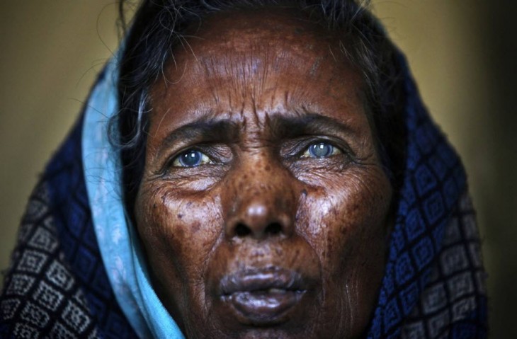 mujer ciega por cataratas en nepal