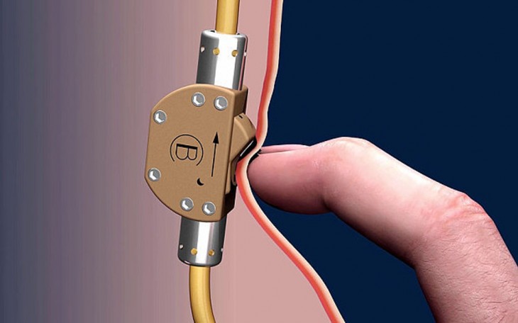 Prototipo del método anticonceptivo Bimek SLV 