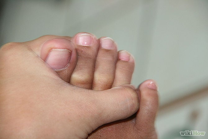 pie de una persona intentando separar su dedo pequeño del pie 