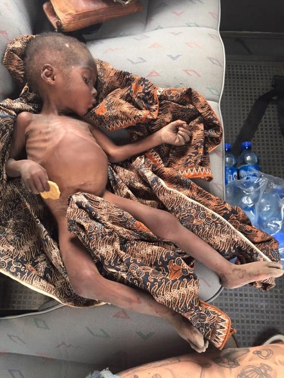 Niño nigeriano acusado de brujo con severa desnutrición