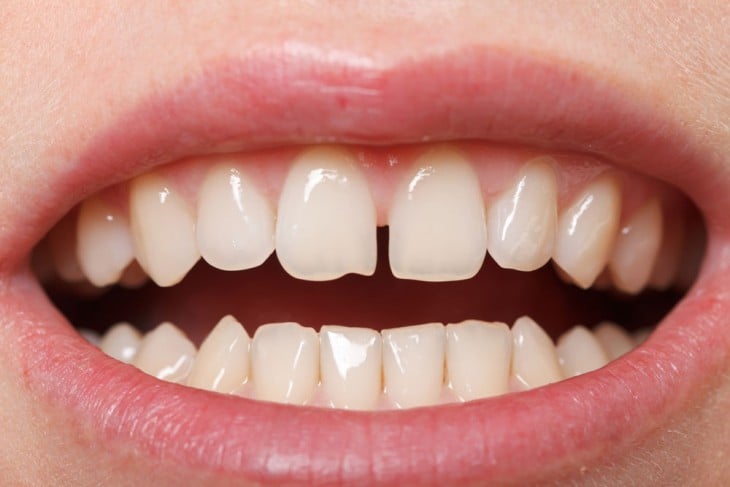 diastema es el espacio entre los dientes 