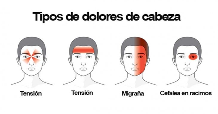 ilustración que muestra los tipos de dolores de cabeza 