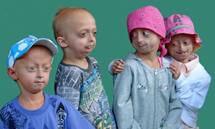 SÍNDROME DE PROGERIA ATACA A UNA FAMILIA