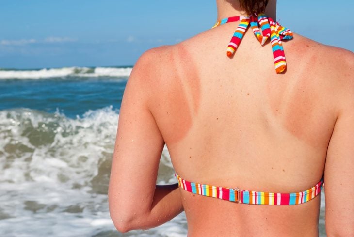 espalda de mujer con quemadura solar en la playa