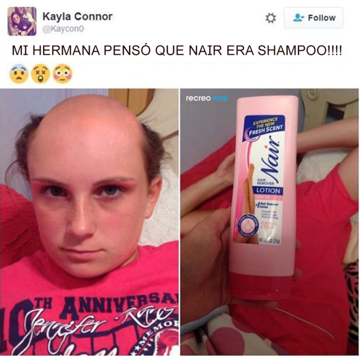 Mujer pelona porque se lavó el cabello con Nair