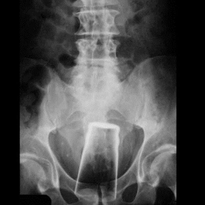 vaso en pelvis radiografía 