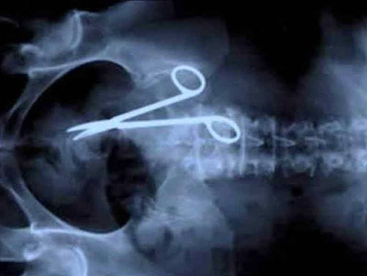 radiografía tijeras dentro de persona