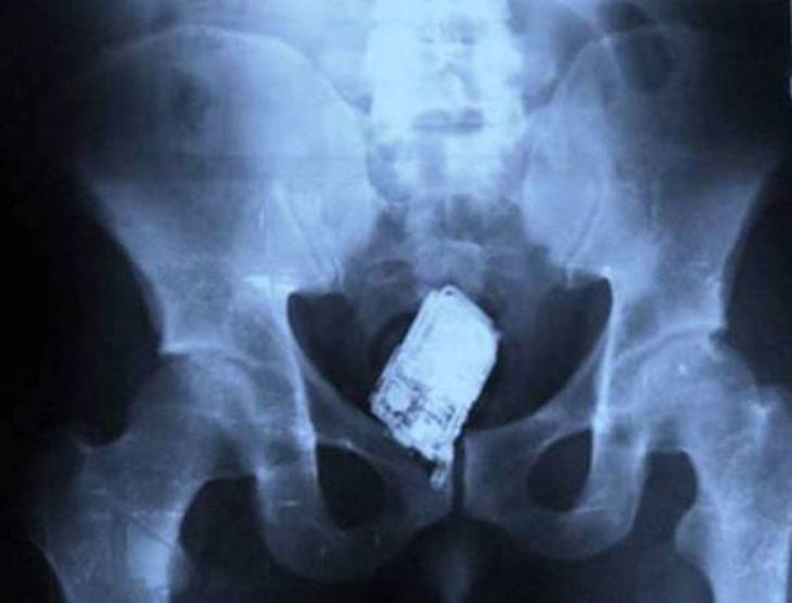 teléfono celular en pelvis radiografía 