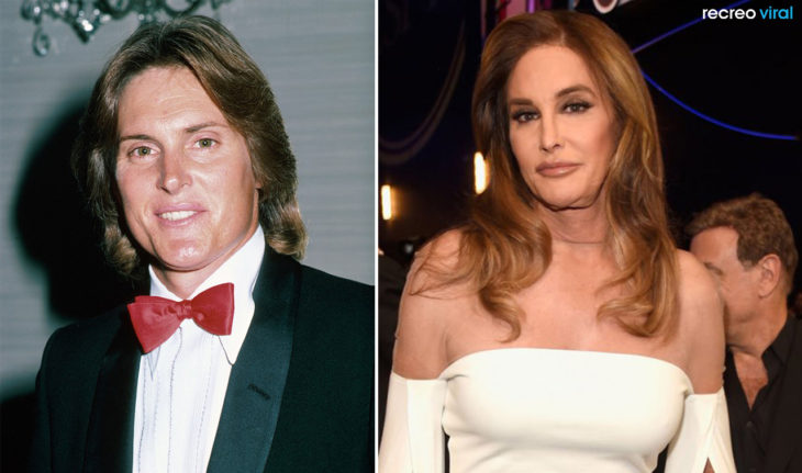 Cirugías. Bruce Jenner y Caitlyn Jenner
