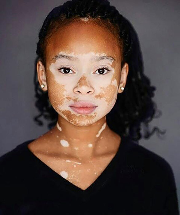 niña con vitiligo