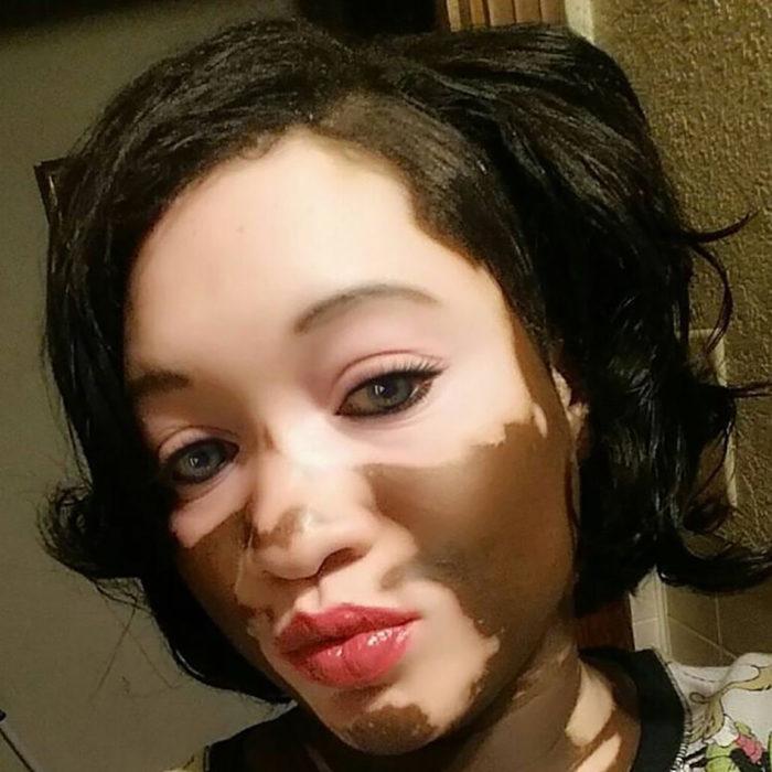 mujer con vitiligo y ojos verdes