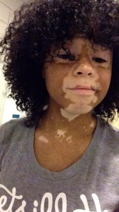 niña con vitiligo