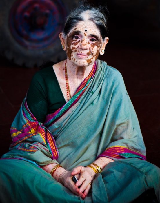 mujer de la india con vitiligo 