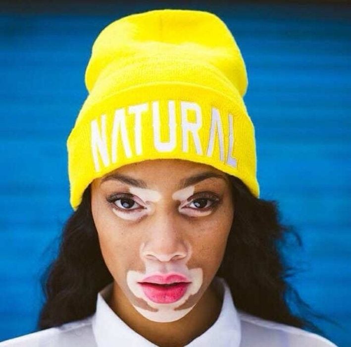 chica con vitiligo y sombrero amarillo