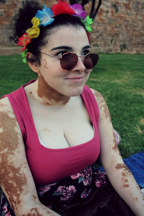 chica con vitiligo y corona de flores
