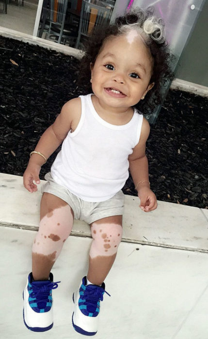 niña pequeña con piel y cabello despigmentados