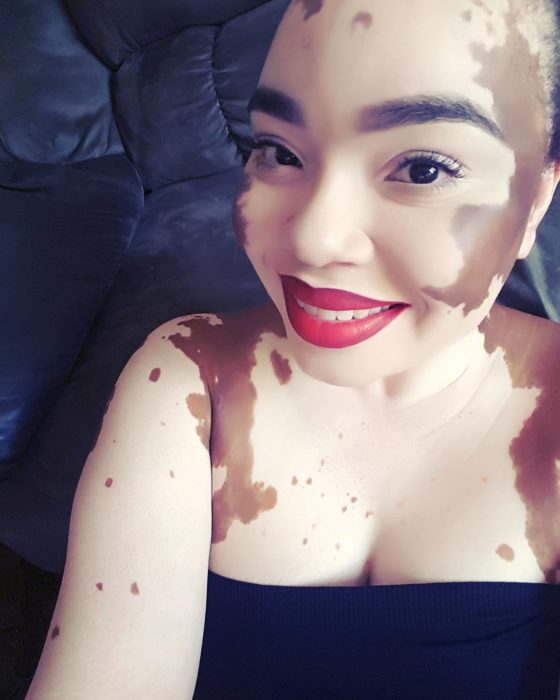 mujer en el coche con vitiligo