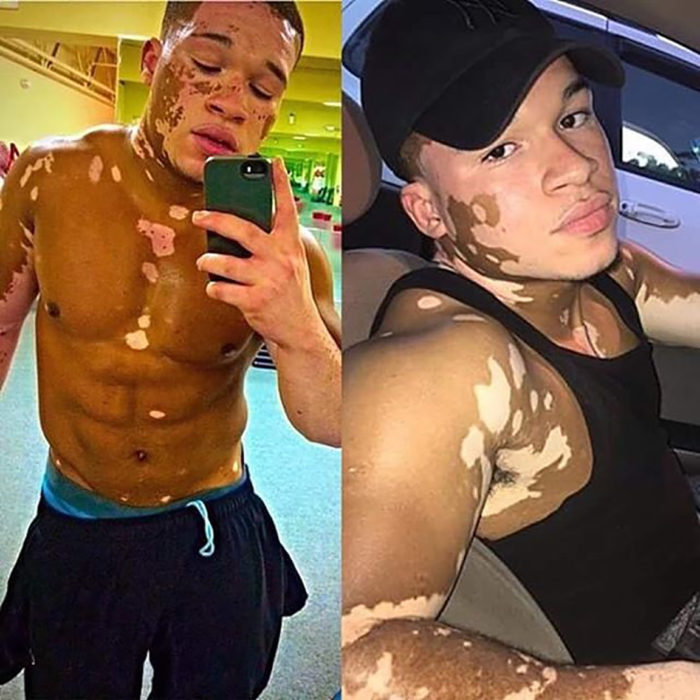 modelo masculino con vitiligo