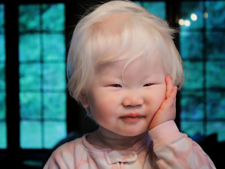 Niña china albina 