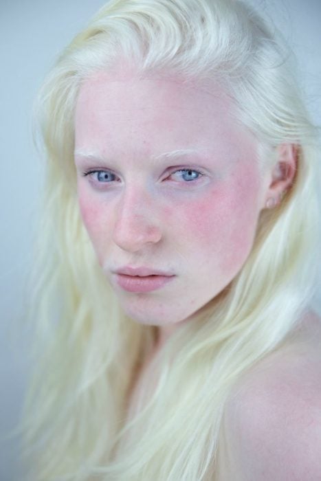 Mujer albina rostro rojizo