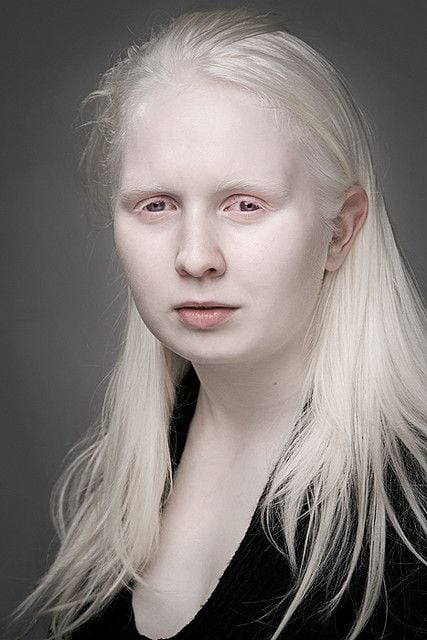 Joven albina