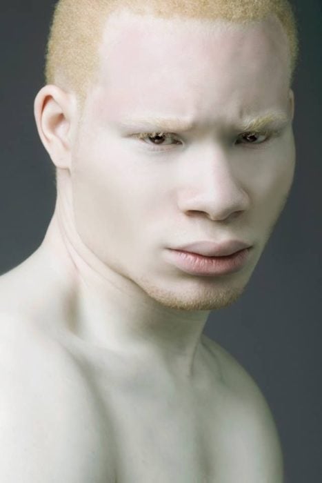 Hombre albino