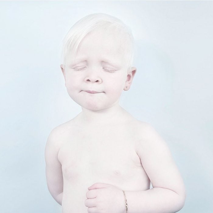 Niño albino con ojos cerrados