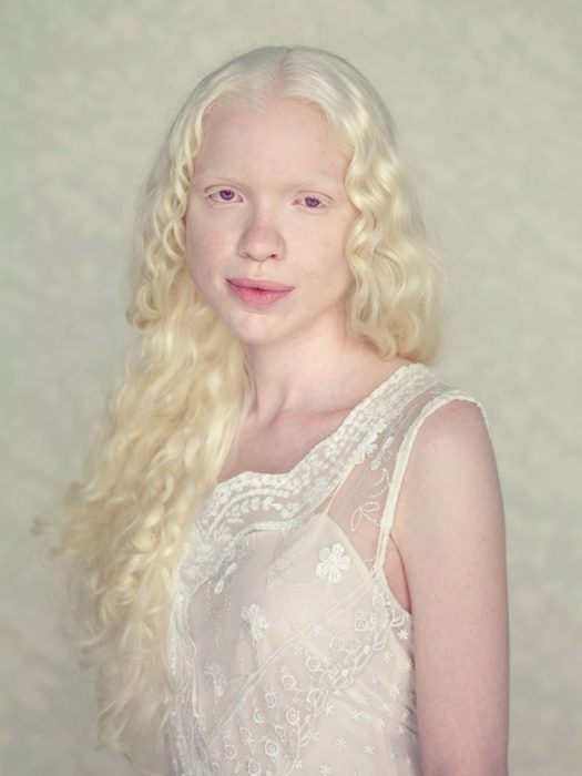 Niña albina viendo a la cámara