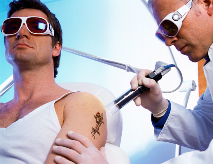 borrar tatuajes con laser